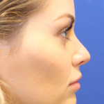 Rhinoplasty Before & After Patient #16814