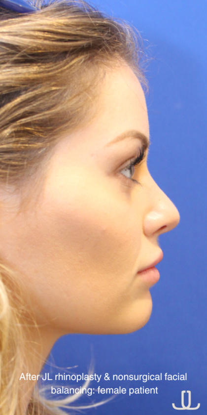 Patient #16814 Rhinoplasty Before and After Photos New York, NY ...