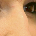 Rhinoplasty Before & After Patient #16754