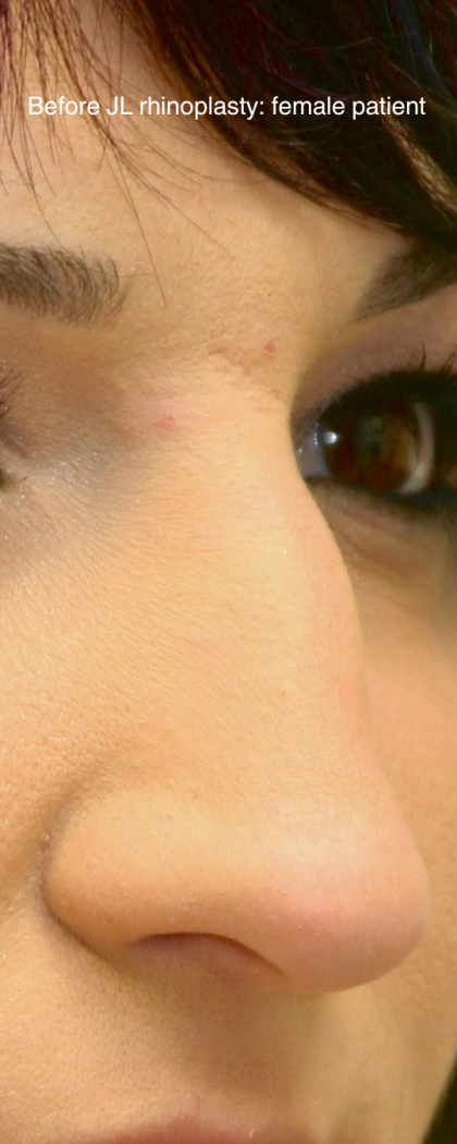 Rhinoplasty Before & After Patient #16754