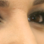 Rhinoplasty Before & After Patient #16754