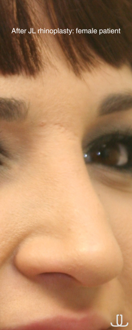 Rhinoplasty Before & After Patient #16754