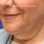 Facelift / Neck Lift Before & After Patient #16745