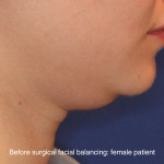 Chin Liposuction Before & After Patient #16743