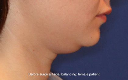 Chin Liposuction Before & After Patient #16743