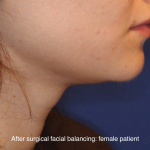 Chin Liposuction Before & After Patient #16743