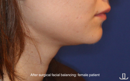Chin Liposuction Before & After Patient #16743
