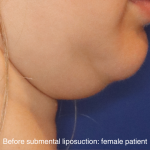 Chin Liposuction Before & After Patient #16744