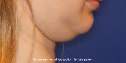 Chin Liposuction Before & After Patient #16744