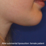 Chin Liposuction Before & After Patient #16744