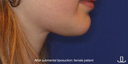 Chin Liposuction Before & After Patient #16744