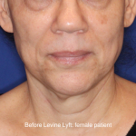 Facelift / Neck Lift Before & After Patient #16746