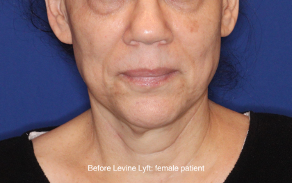 Facelift / Neck Lift Before & After Patient #16746
