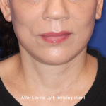 Facelift / Neck Lift Before & After Patient #16746