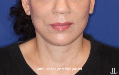 Facelift / Neck Lift Before & After Patient #16746