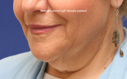 Facelift / Neck Lift Before & After Patient #16745