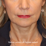 Facelift / Neck Lift Before & After Patient #16747