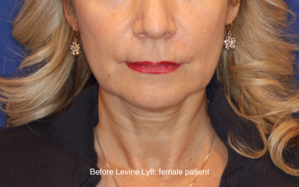 Facelift / Neck Lift Before & After Patient #16747