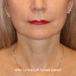 Facelift / Neck Lift Before & After Patient #16747