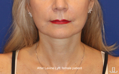 Facelift / Neck Lift Before & After Patient #16747