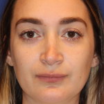JL Facial Balancing Before & After Patient #16748