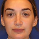 JL Facial Balancing Before & After Patient #16748