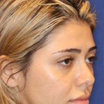 JL Facial Balancing Before & After Patient #16749