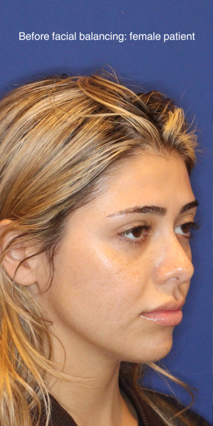 JL Facial Balancing Before & After Patient #16749