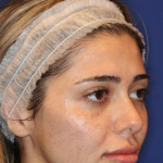 JL Facial Balancing Before & After Patient #16749
