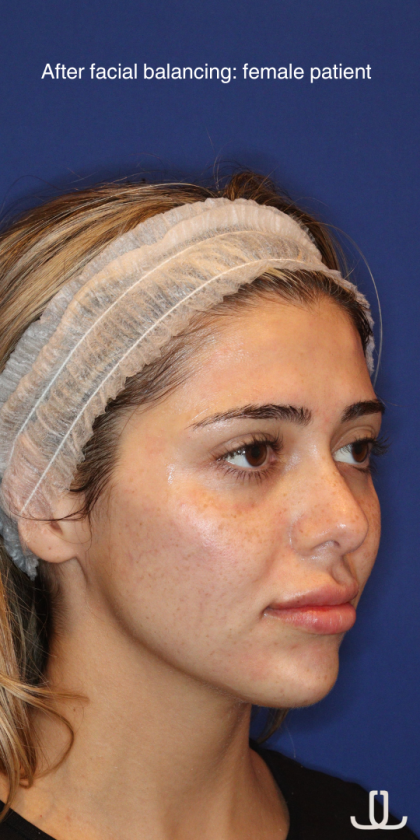 JL Facial Balancing Before & After Patient #16749
