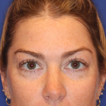 JL Facial Balancing Before & After Patient #16750