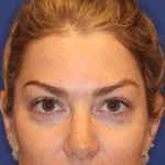 JL Facial Balancing Before & After Patient #16750