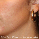 Skin Resurfacing & IPL Lasers Before & After Patient #16751