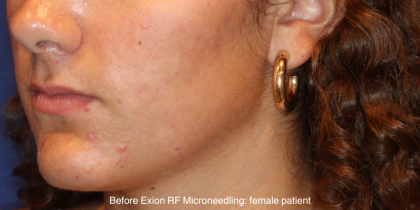 Skin Resurfacing & IPL Lasers Before & After Patient #16751
