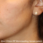 Skin Resurfacing & IPL Lasers Before & After Patient #16751