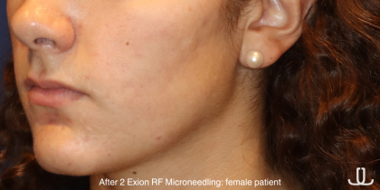 Skin Resurfacing & IPL Lasers Before & After Patient #16751