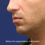 Chin Augmentation Before & After Patient #16741