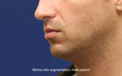 Chin Augmentation Before & After Patient #16741