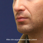 Chin Augmentation Before & After Patient #16741