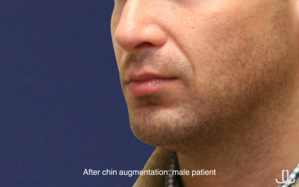 Chin Augmentation Before & After Patient #16741