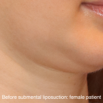 Chin Liposuction Before & After Patient #16744