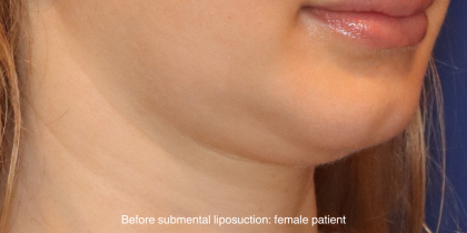 Chin Liposuction Before & After Patient #16744
