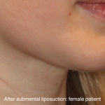 Chin Liposuction Before & After Patient #16744