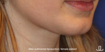 Chin Liposuction Before & After Patient #16744