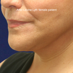 Facelift / Neck Lift Before & After Patient #16745