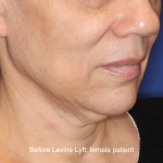 Facelift / Neck Lift Before & After Patient #16746