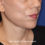 Facelift / Neck Lift Before & After Patient #16746