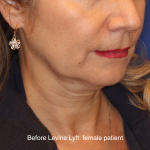 Facelift / Neck Lift Before & After Patient #16747