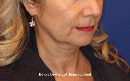 Facelift / Neck Lift Before & After Patient #16747