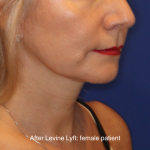 Facelift / Neck Lift Before & After Patient #16747